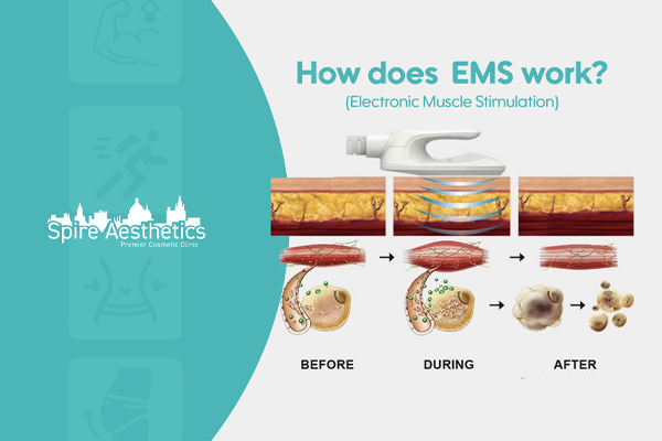 EMS treatment for post pregnancy weight loss treatment Olney