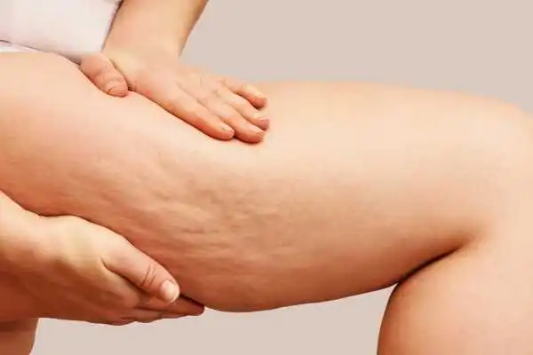Image of woman showing leg with cellulite Olney