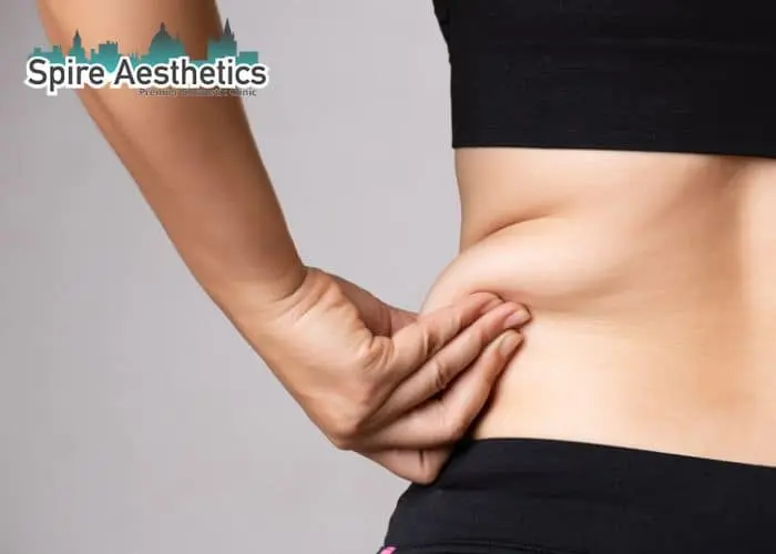 Image of woman pinching fat on their hips Olney. Fat Freezing treatment