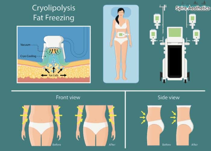 Image of diet and fat freezing combined for best results for Spire Aesthetics Olney