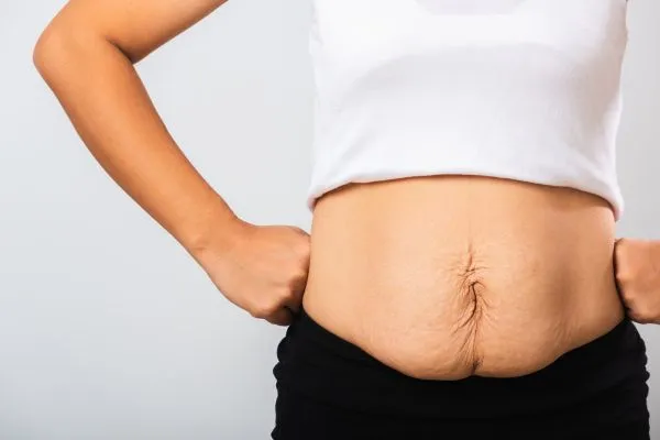 Image of a woman's stomach after weight loss with sagging skin following a gastric band Olney