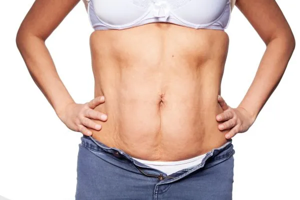 sagging skin on woman's stomach after weight loss injections Olney