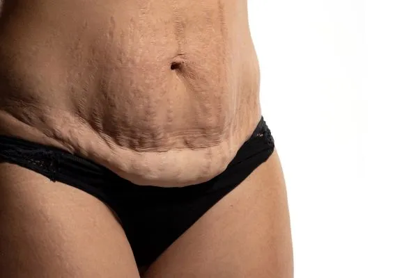 Image of womans stomach after weight loss injections Olney showing saggy skin
