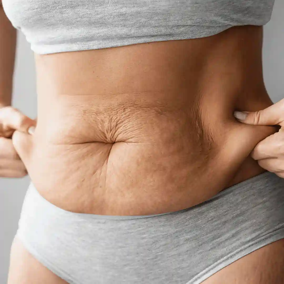 Is It Normal to Have Loose Skin After Pregnancy Olney?