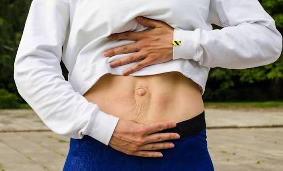 When Could Diastasis Recti Be the Missing Piece of the Puzzle Olney?