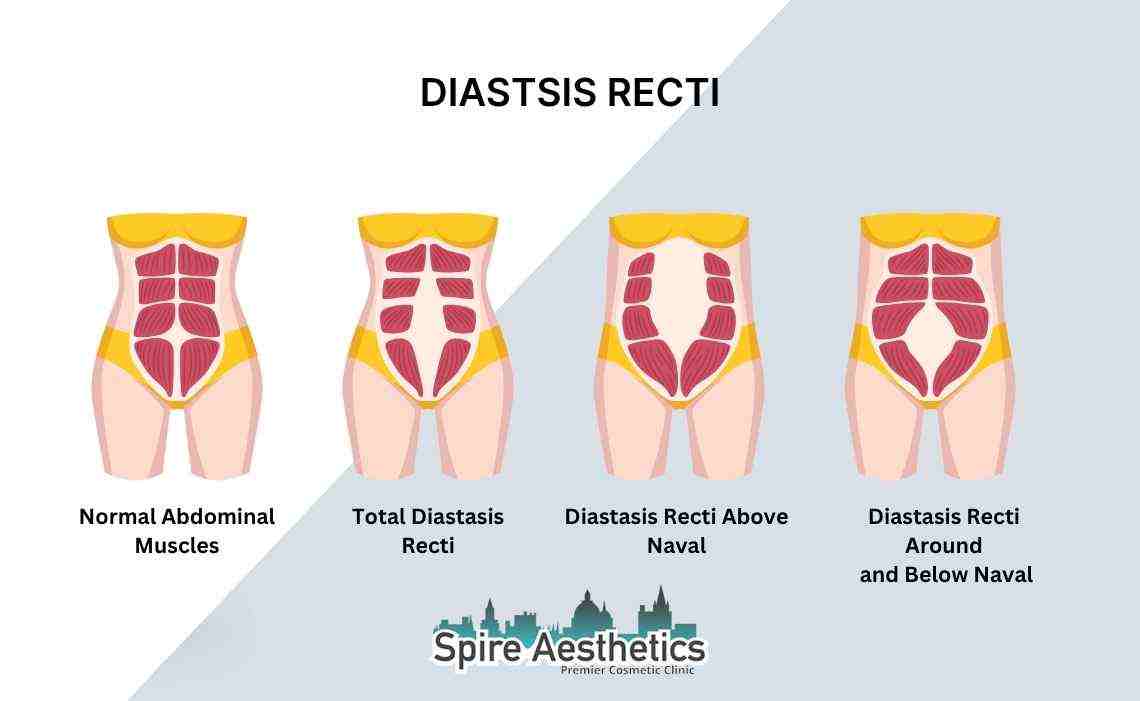Is Non-Surgical Diastasis Recti Treatment Right for You? Common Concerns Answered Olney